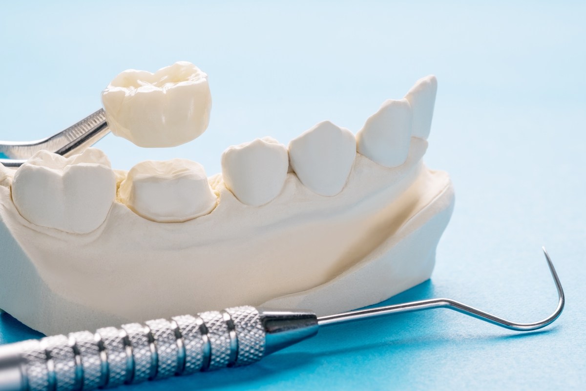 Mockup of dentures at Dr. Fatemeh Hadjian's dental practice